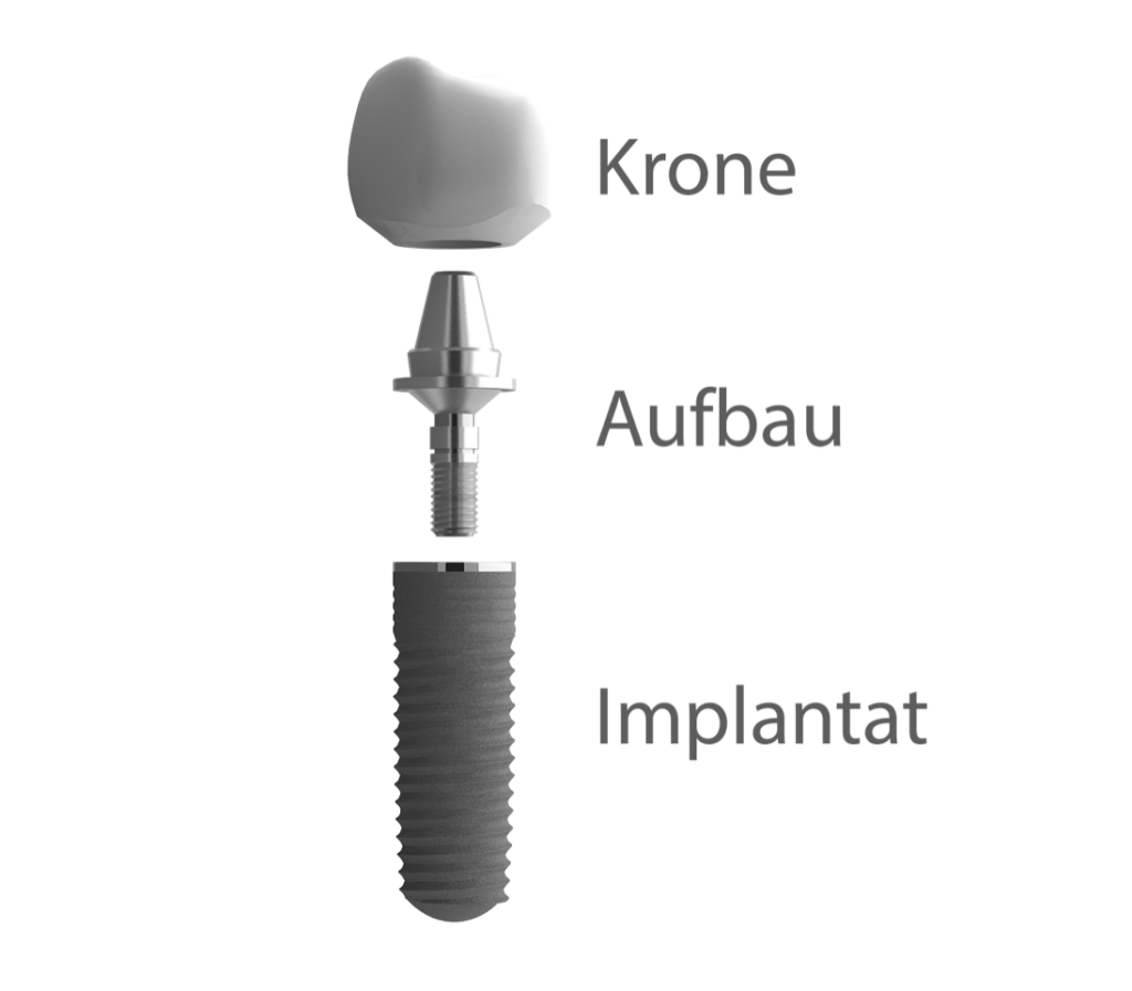 Dentallabor Werner — Zahnimplantate aus Geldern